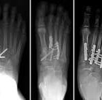 Lisfranc Joint Injury