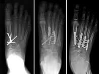 Lisfranc Joint Injury